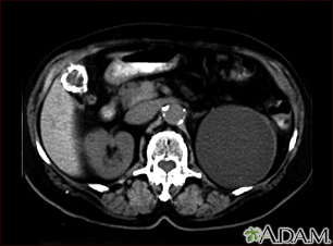 Kidney cyst with gallstones, CT scan