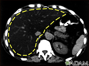 Fatty liver, CT scan