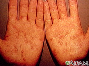Syphilis, secondary on the palms