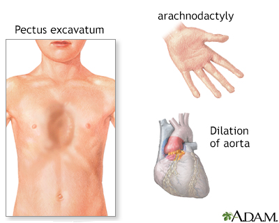 Marfan's syndrome